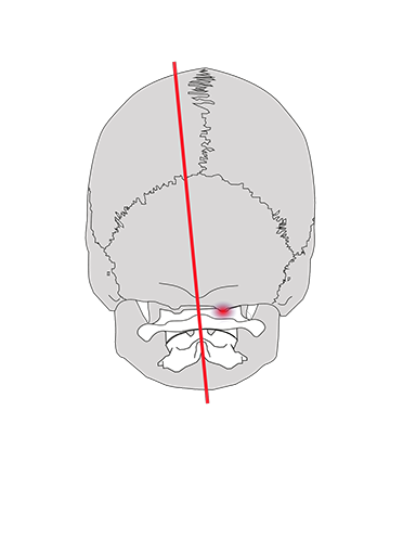 Décalage de l'atlas, dissymétrie, compression du crâne, schéma compensatoire du corps, articulations en force et tisssus inflammés.